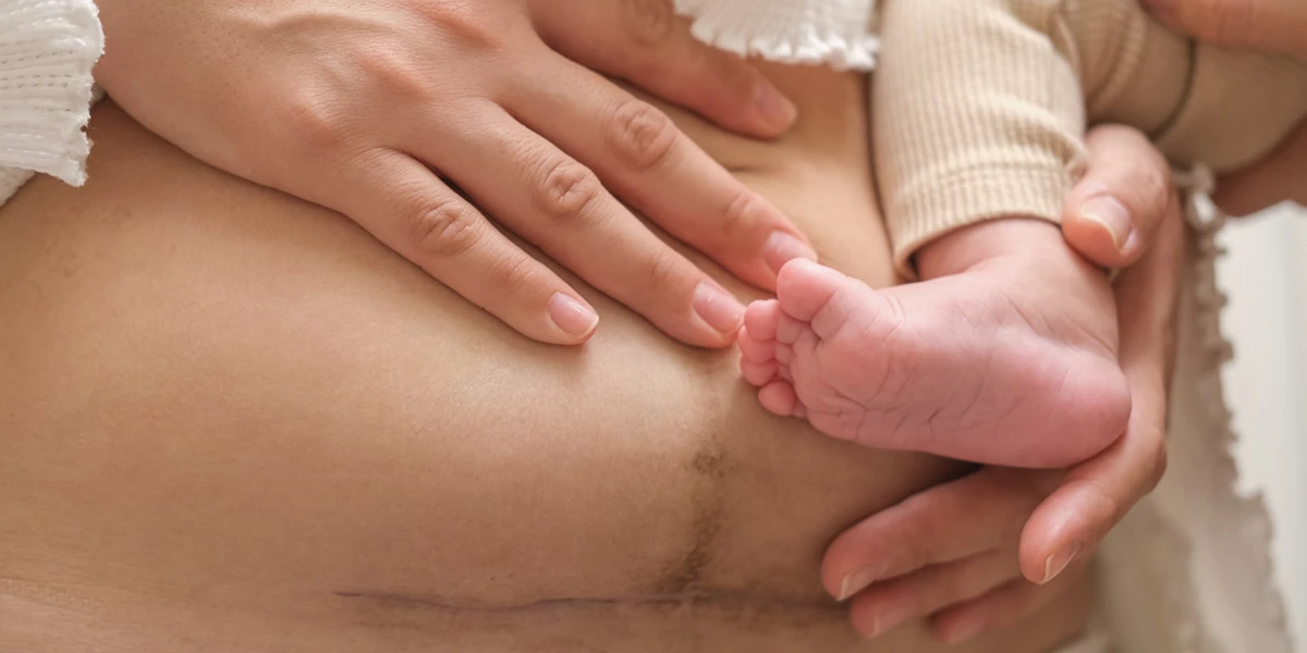 Paquete de maternidad cesárea